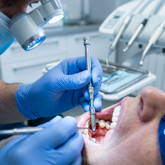 İmplant Tedavisinde Dikkat Edilmesi Gerekenler